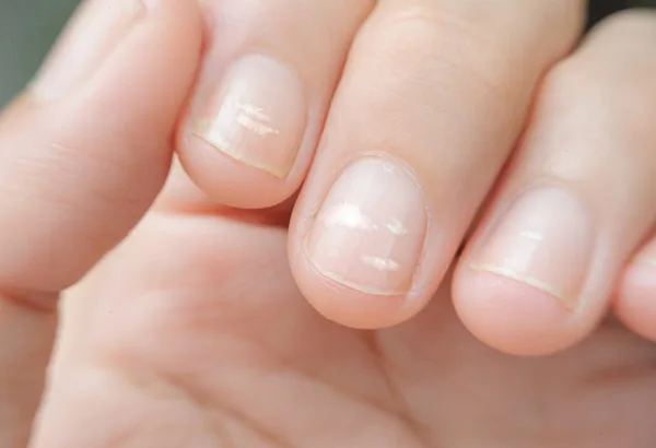 White Spots on Nails