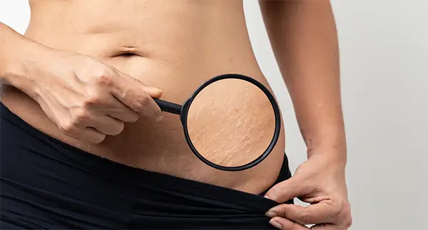 How to Get Ride of Stretch Marks