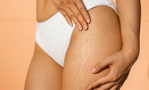 Professional Medical Treatments for stretch marks