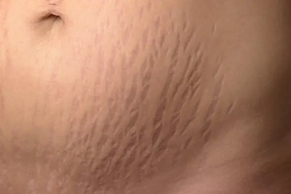 How to Get Ride of Stretch Marks